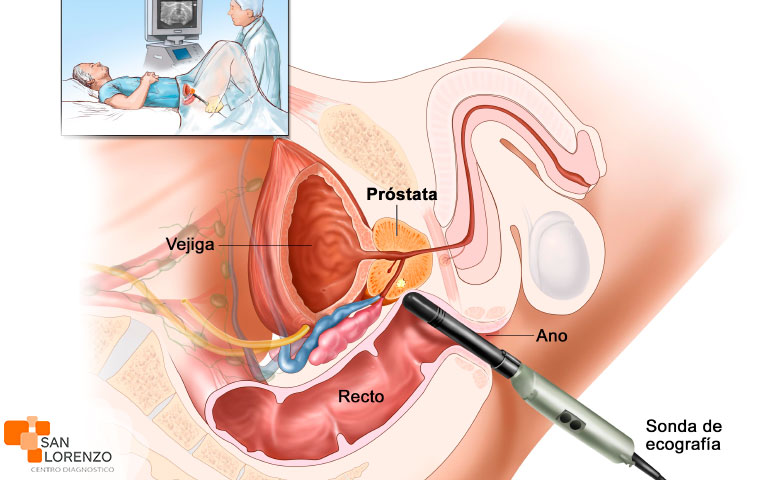 cancer-de-prostata