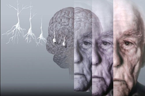 Importancia de un diagnóstico oportuno de alzheimer